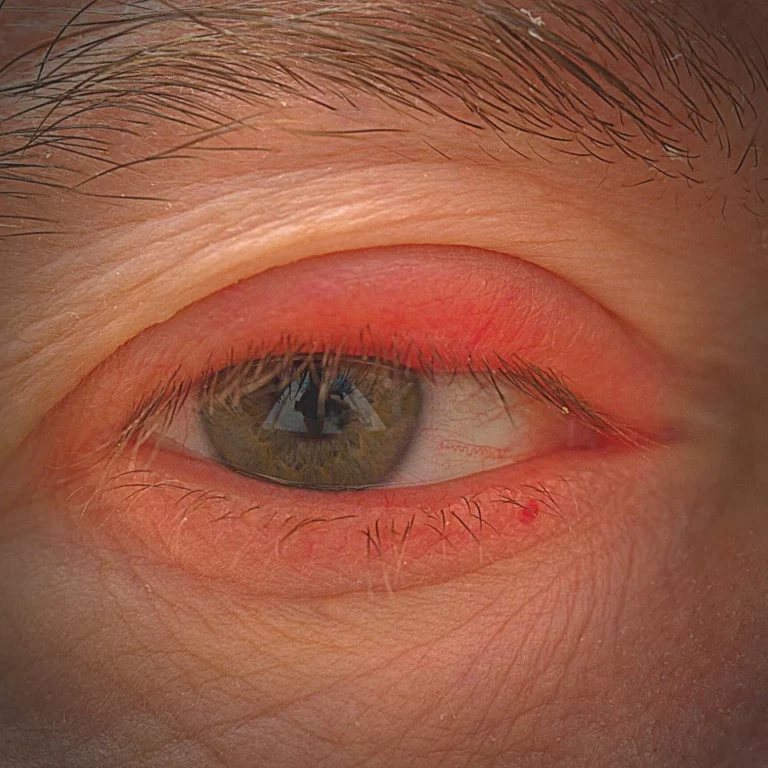 Preseptal Cellulitis