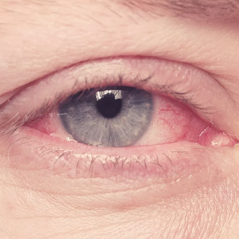 Do I Have Pink Eye Quiz