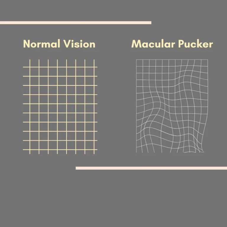 Epiretinal Membrane (Macular Pucker): Causes, Symptoms, and Treatment
