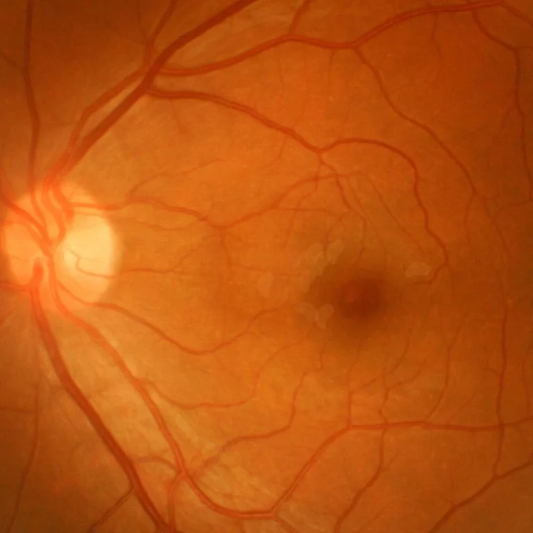 Wet Vs Dry Macular Degeneration