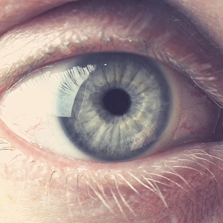 Dry Eyes With Contacts