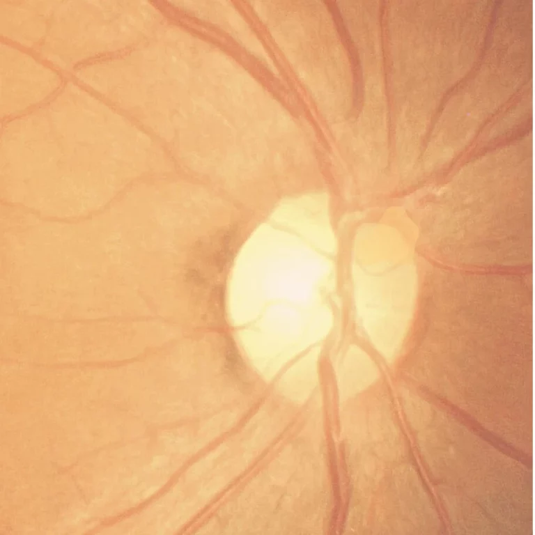 Optic Nerve Drusen