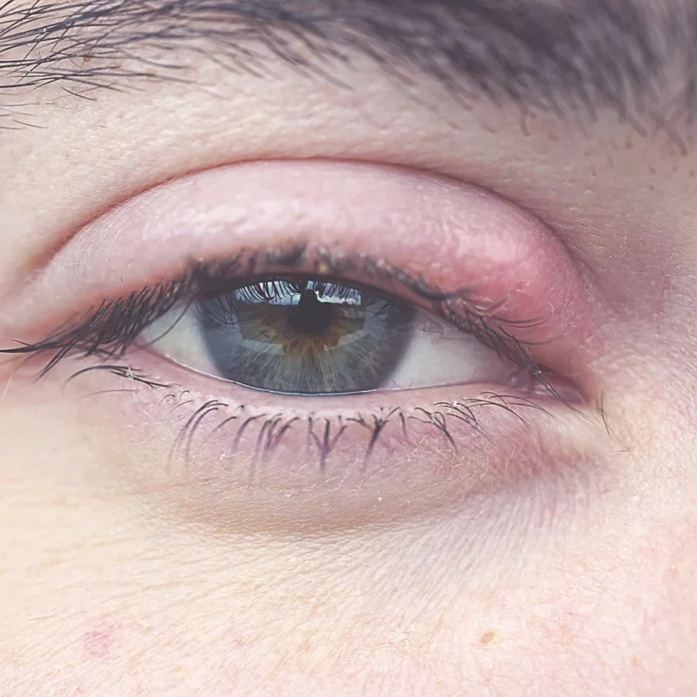 Chalazion Treatment : Top 5 Methods