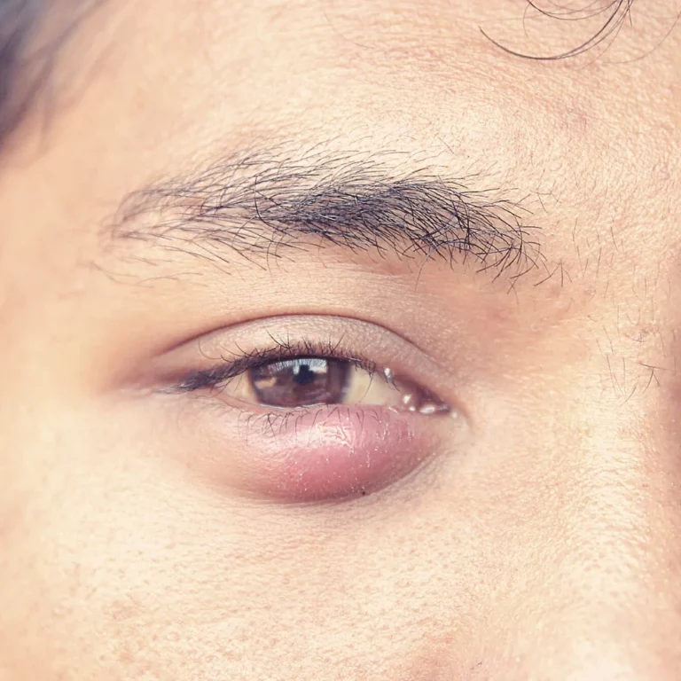 Stye Vs Chalazion
