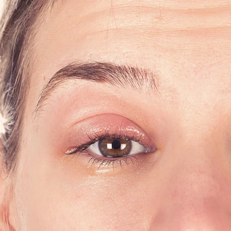 Demodex Blepharitis