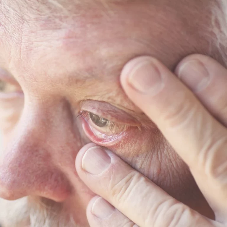 Eyelid Ectropion