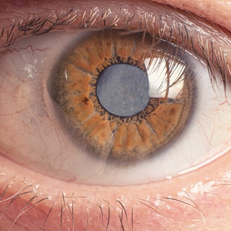 Can Eye Cataracts Be Reversed Without Surgery?